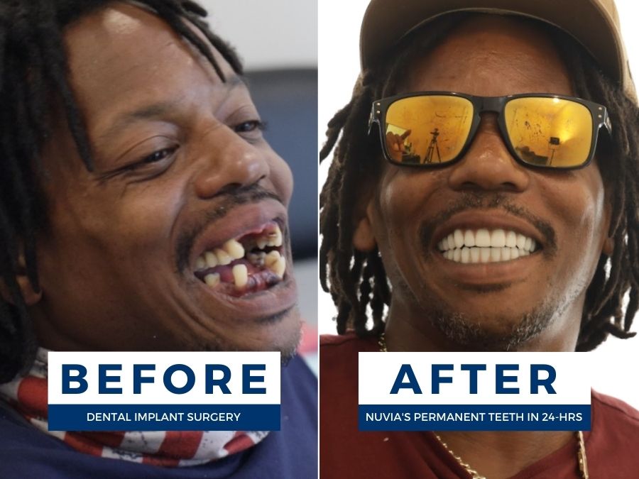 Man smiling before and after getting full mouth dental implants