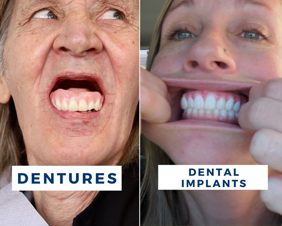 Side by side of a patient wearing dentures and another patient with permanent zirconia teeth
