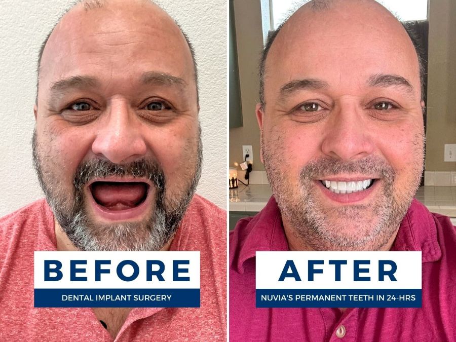 Randee smiling before and after getting full mouth dental implants