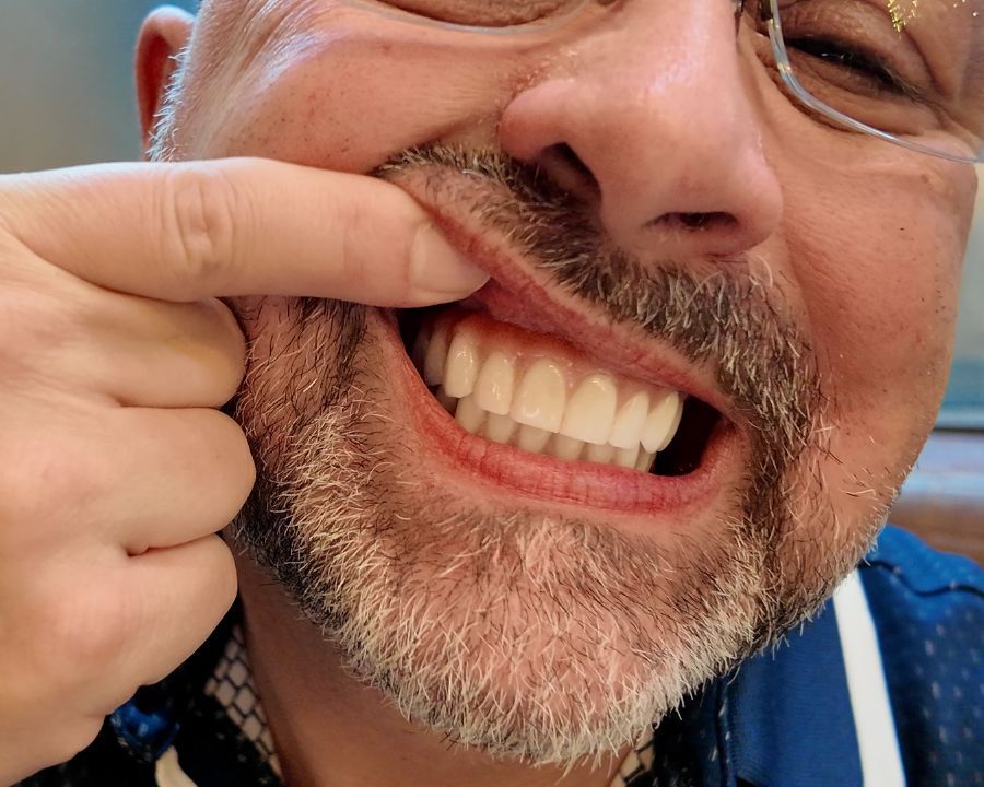 Randee pulling up lip to show top dental implants