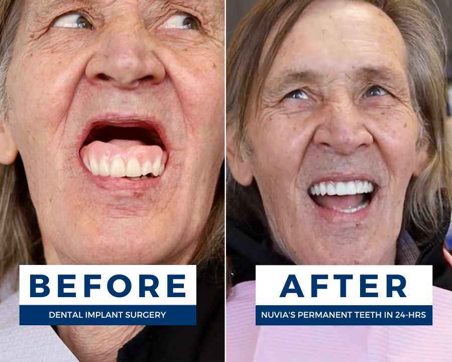 Michael smiling with his dentures vs smiling with his new permanent teeth