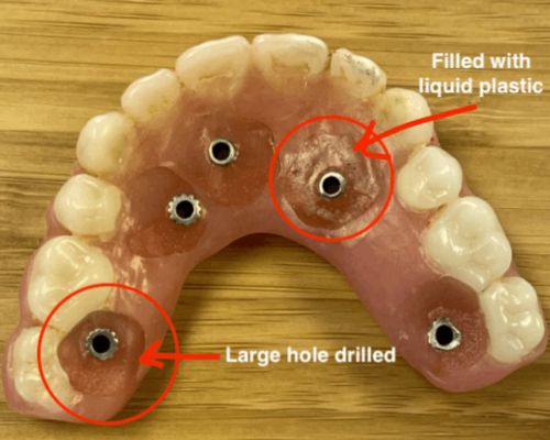 Image of an uncomfortable temporary denture with large holes and liquid plastics