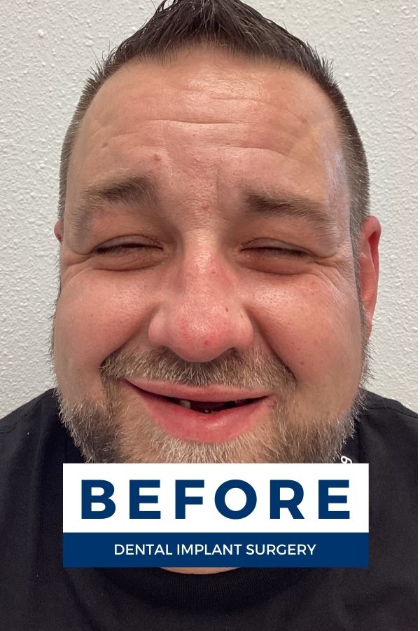Shaun smiling with failing and missing teeth before getting dental implants