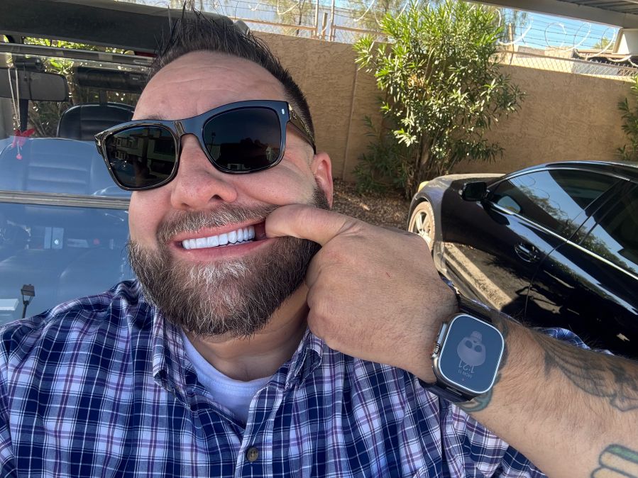 Shaun pulling back lip to show new teeth with dental implants despite the implant failure