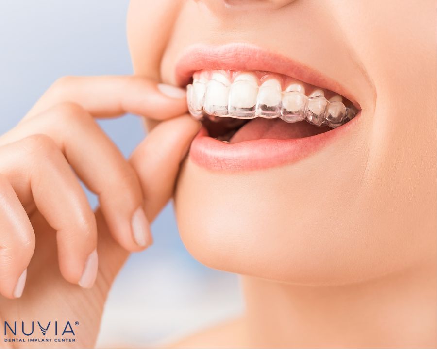 Image of a mouthguard