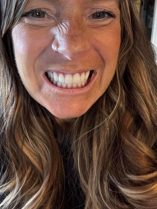 Darcie smiling after getting her dental implants and new zirconia teeth