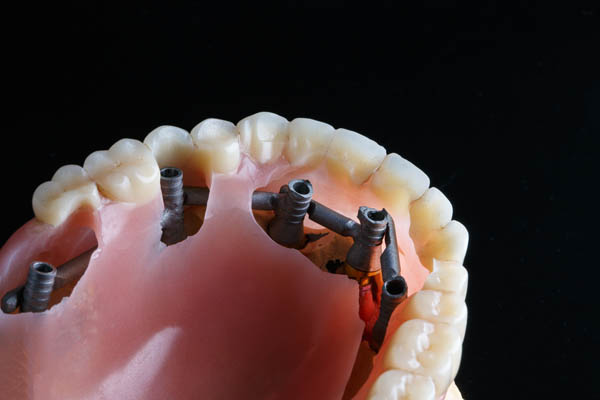 Implant supported dentures
