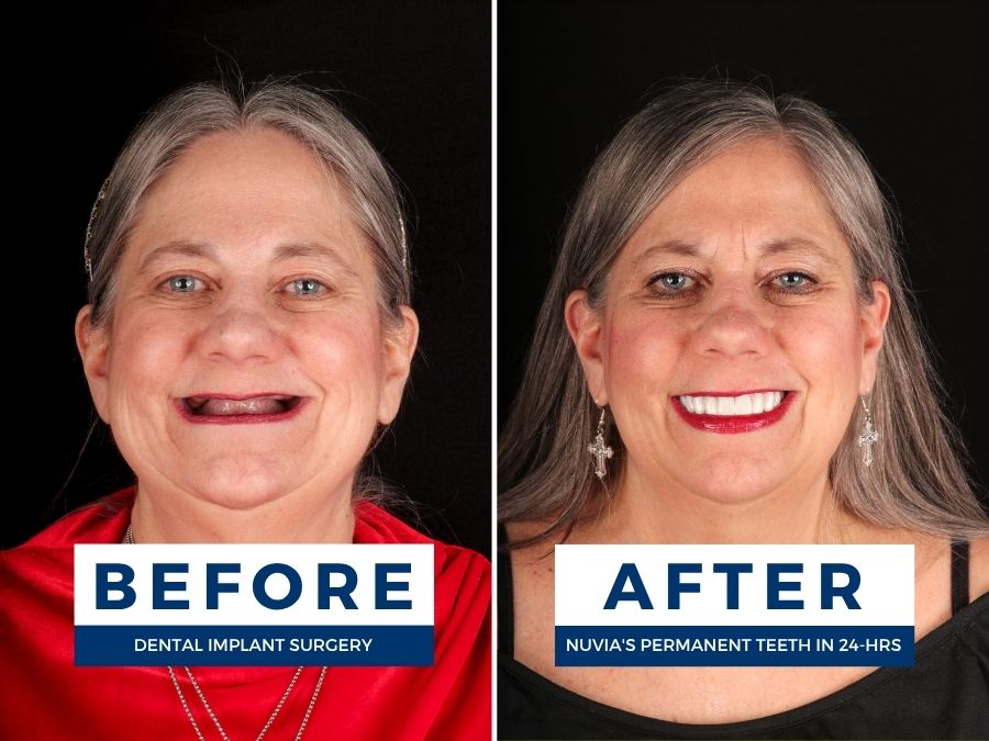 Sheri Thomas Smiling before with dentures and after with dental implants