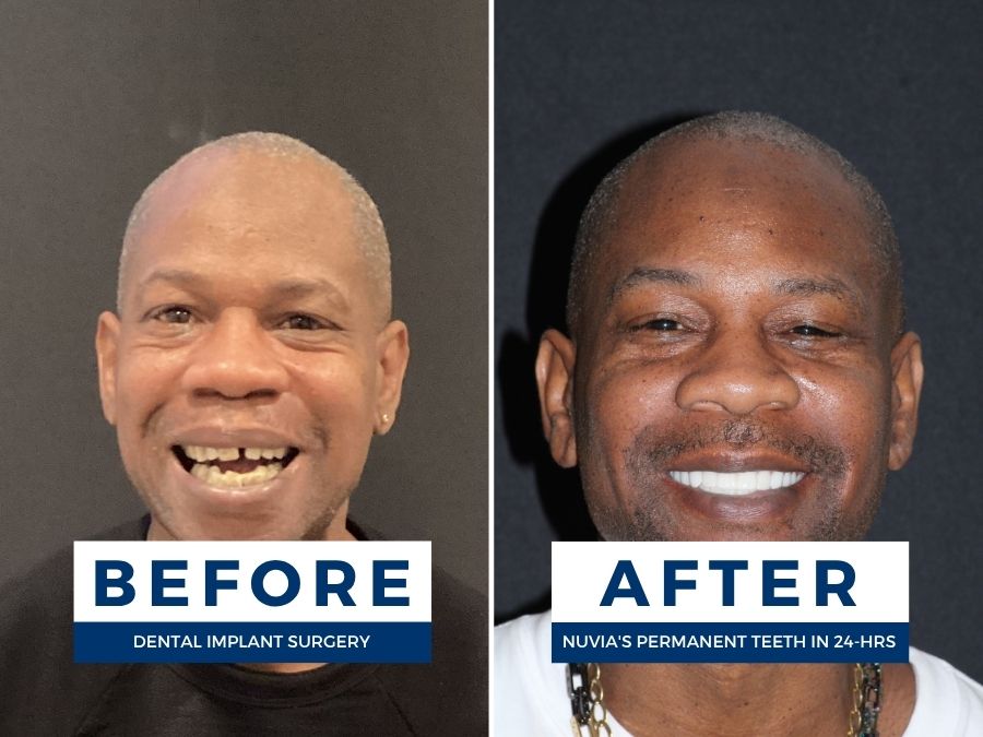 Man smiling before and after getting dental implants