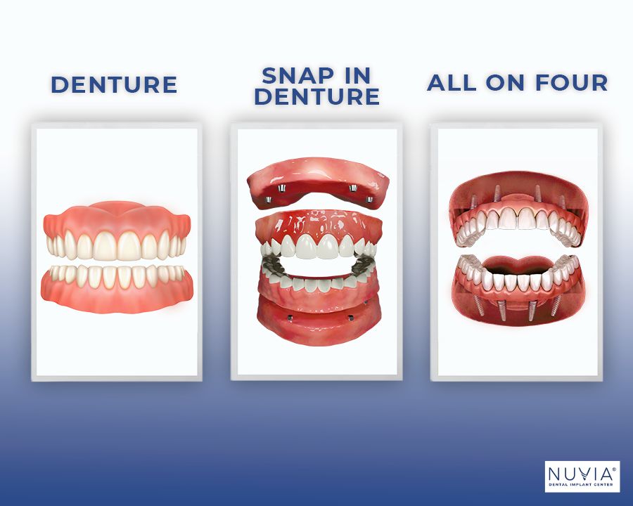 Denture, snap in denture, and permanent denture