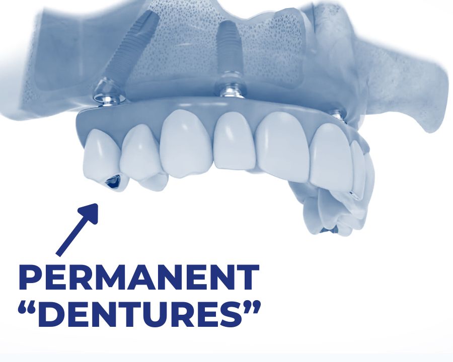 A set of permanent dentures fixed in place by all on 4 dental implants