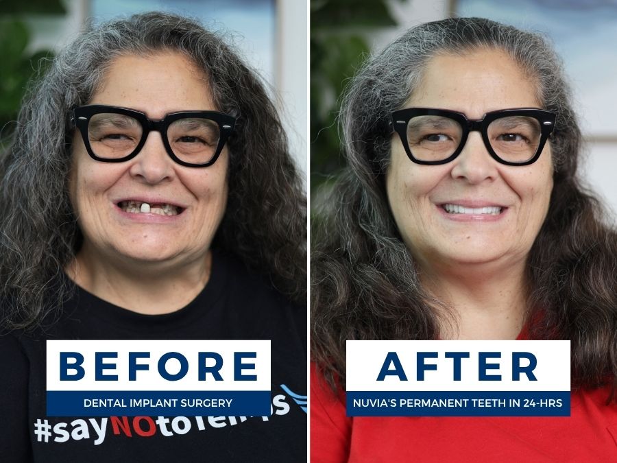Woman smiling before and after getting full mouth dental implants