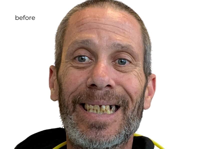 woman before getting dental implants