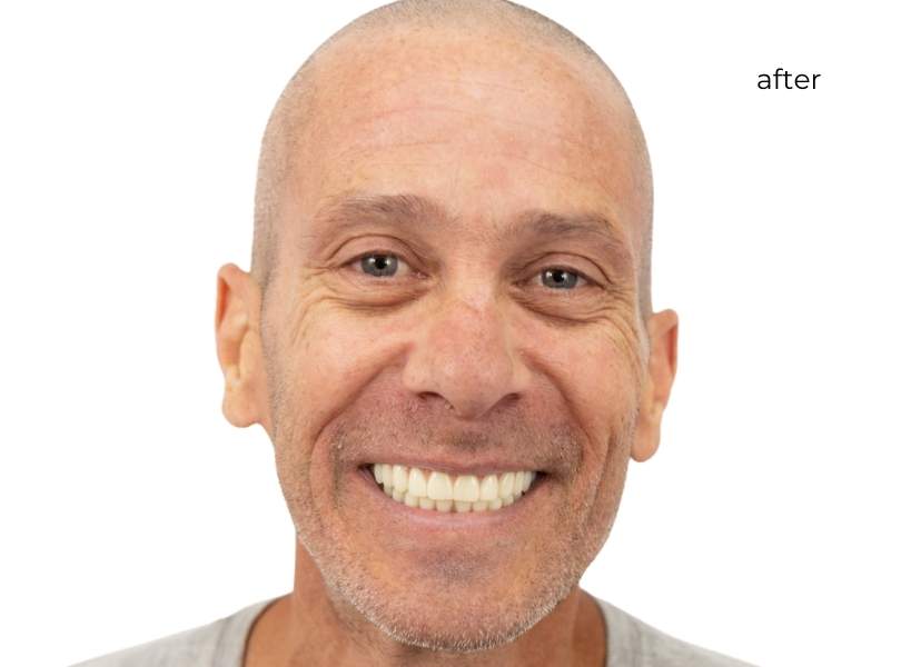 woman after getting dental implants