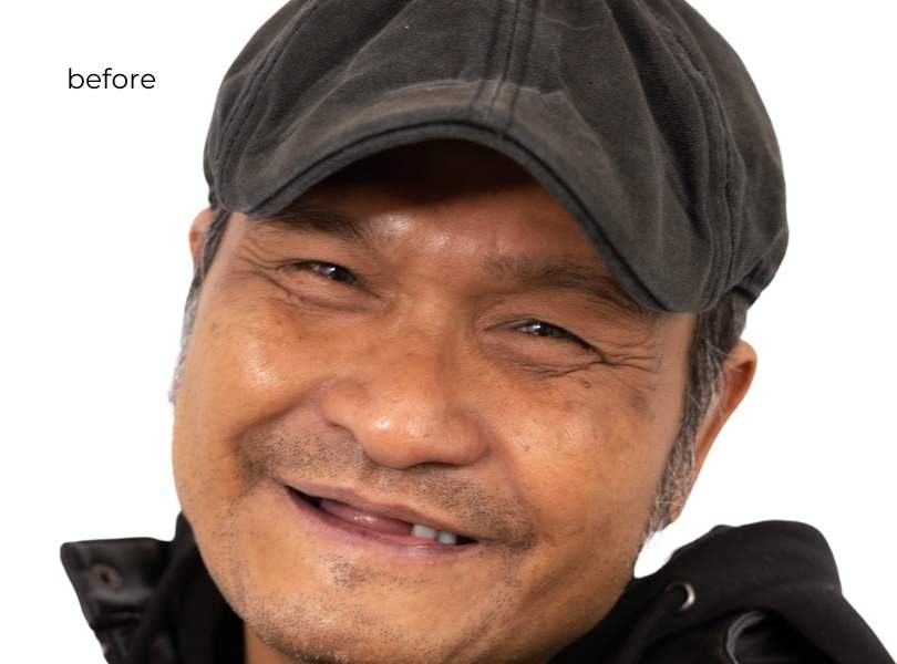 Man smiling before getting dental implants