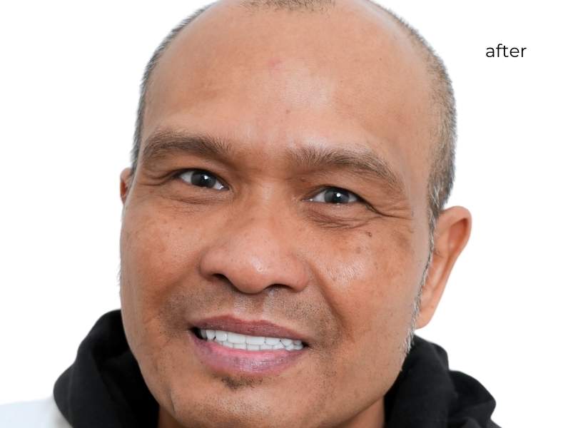 Man smiling after getting dental implants
