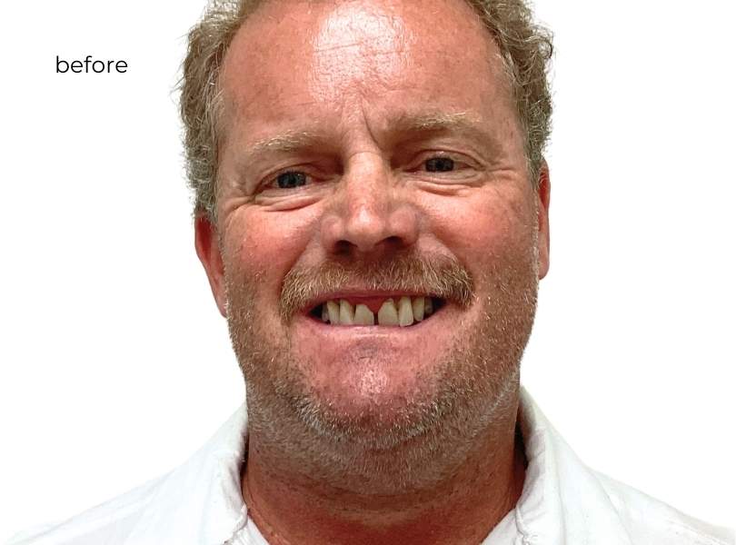 Man smiling before dental implants