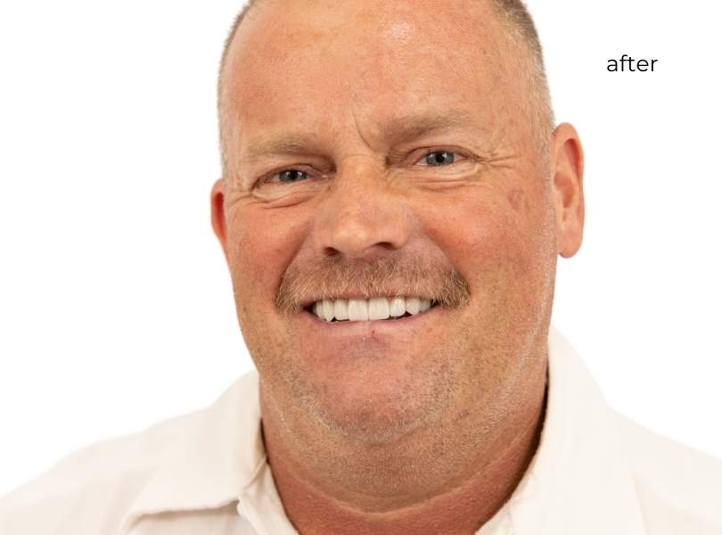 man smiling after getting dental implants