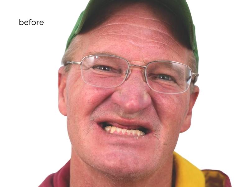 woman smiling before dental implants