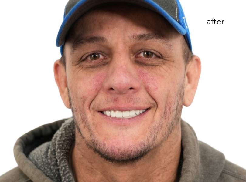 Man smiling after getting dental implants