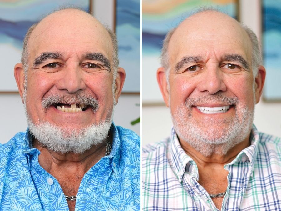 Older gentleman who got dental implants without medicare or medicaid