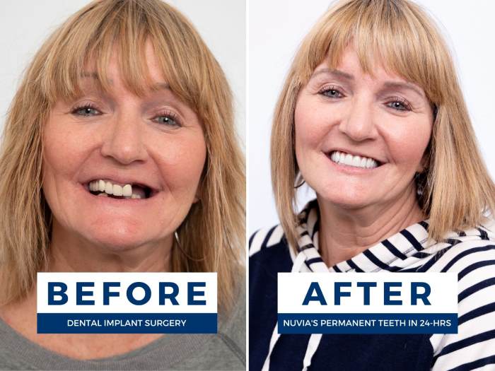 Terri Smiling before and after getting all on 4 instead of 3 on 6