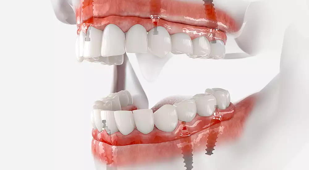 All on 4 graphic showing how the teeth are fixed in place by implants