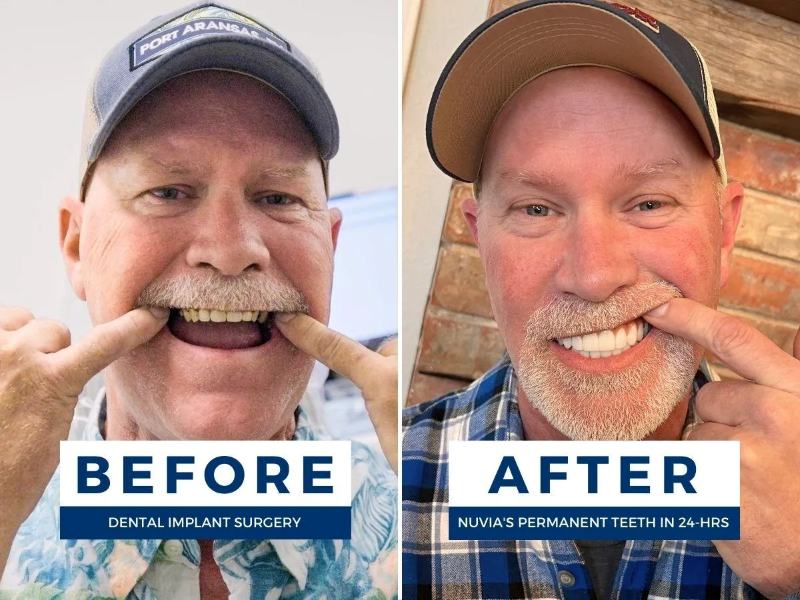 Troy smiling before and after getting dental implants with a heart condition