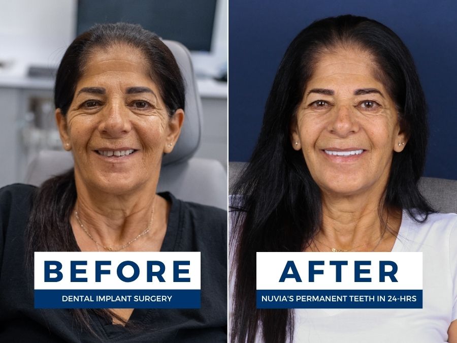 Woman smiling befor and after getting nuvia permanent teeth
