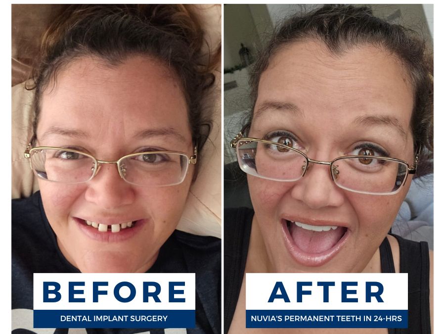 V Smiling before and after financing her new smile with dental implants