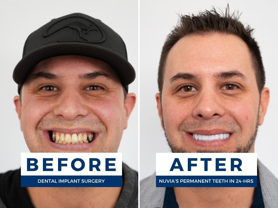 Man who got a full arch restoration at Nuvia Dental Implant Centers