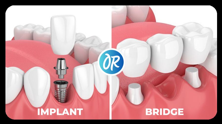single dental implant and bridge of teeth