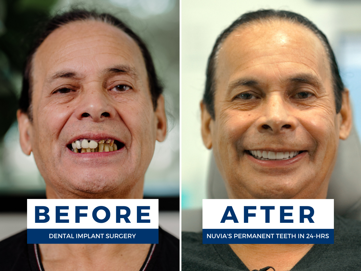 Pedro smiling before and after switching from crowns and bridges to full mouth dental implants