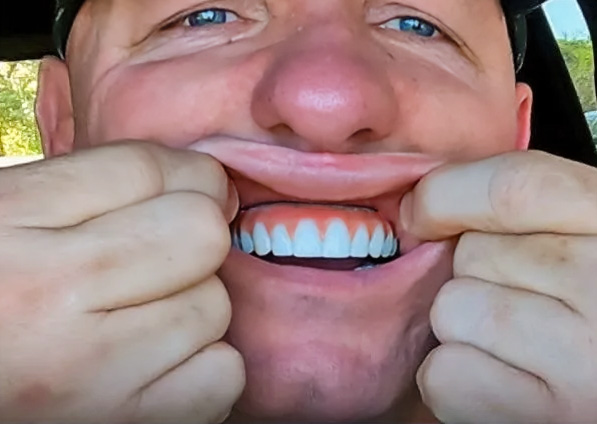Man pulling up lip to show his new teeth and how there is not a gap