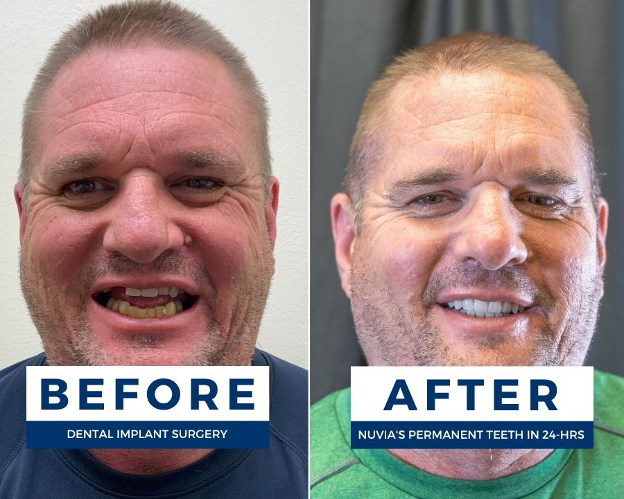 Floyd smiling before and after getting dental implants despite heart failure