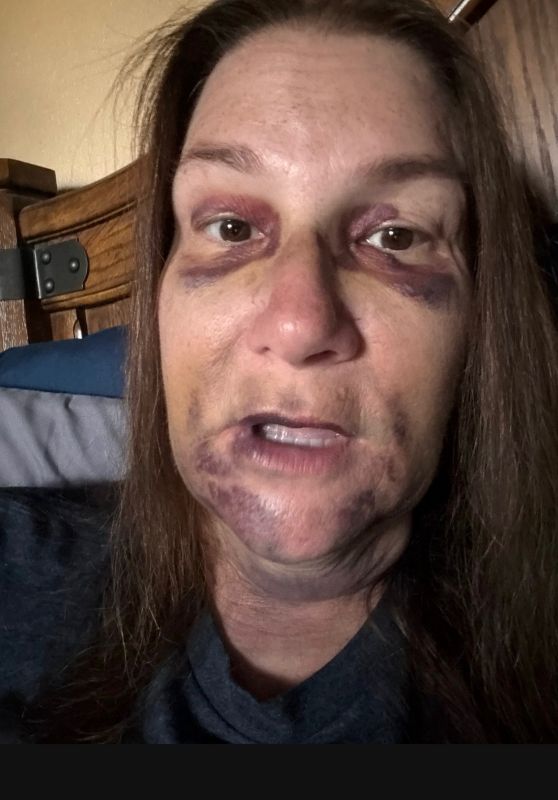 Laurie with bruising after all on 4 dental implant surgery