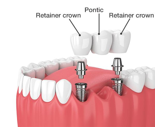 Dental implant timeline for a bridge
