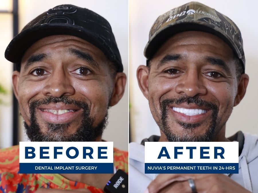 Man smiling before and after same day tooth extraction and implants at Nuvia