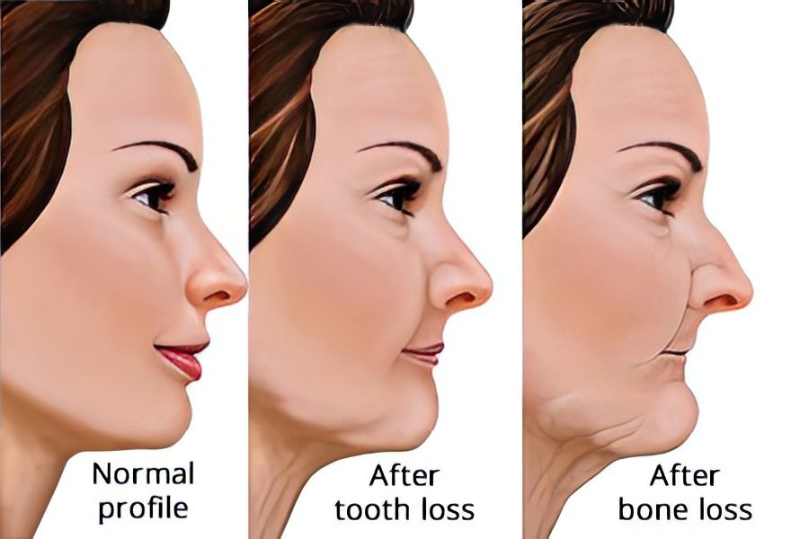 Side by side of a normal profile and a side profile after bone loss