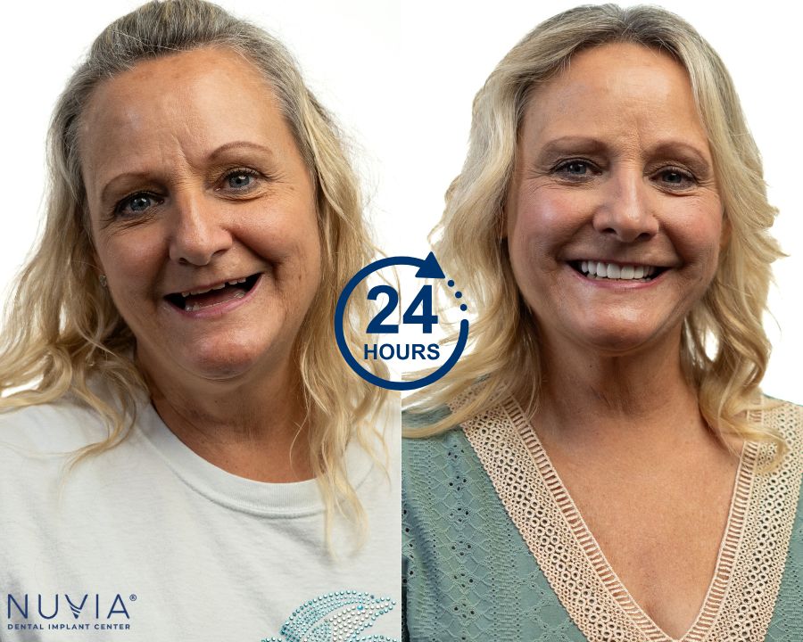 Woman smiling before and after same day tooth extraction and implant at Nuvia