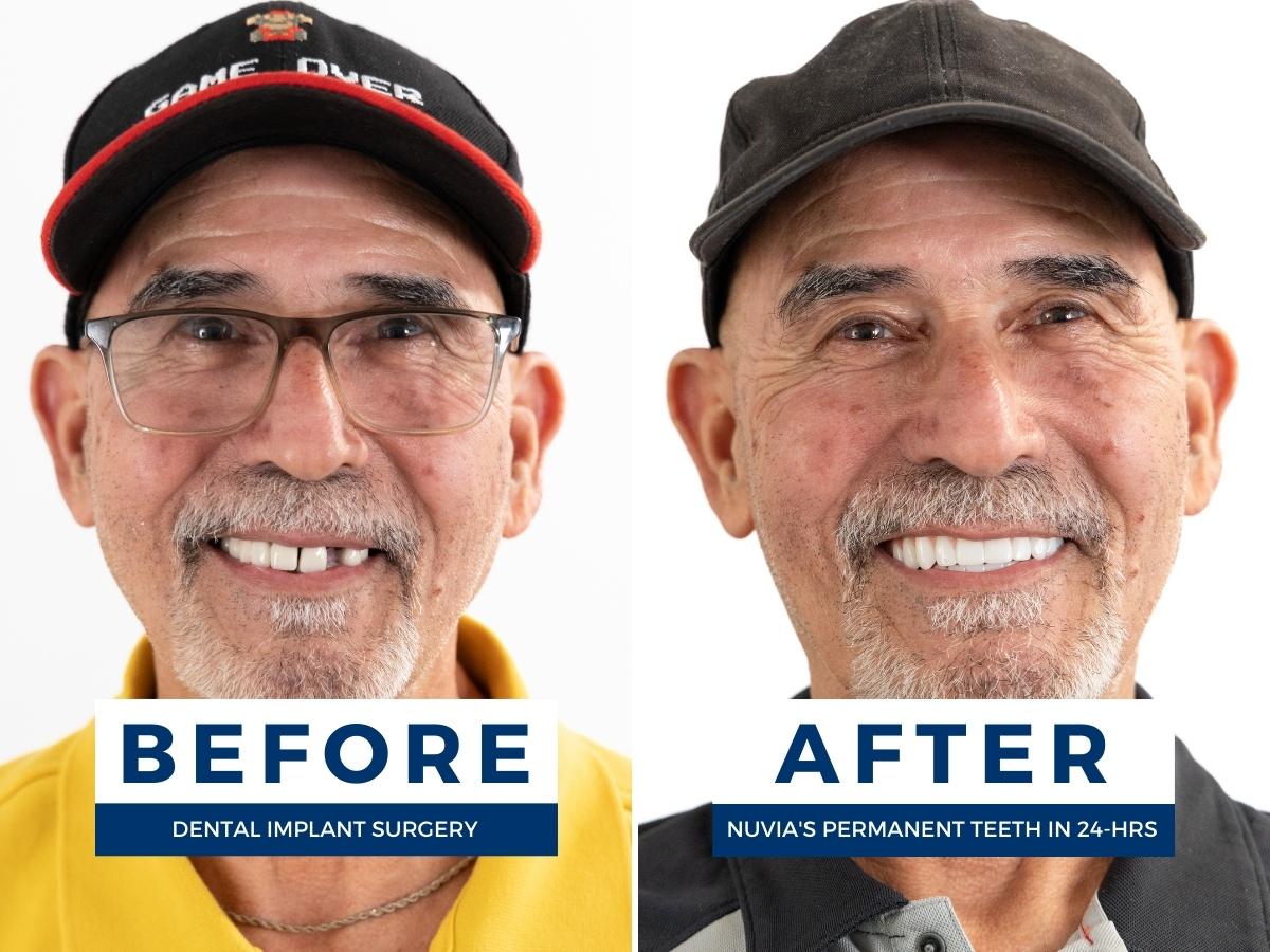 Man smiling before and after getting full mouth dental implants
