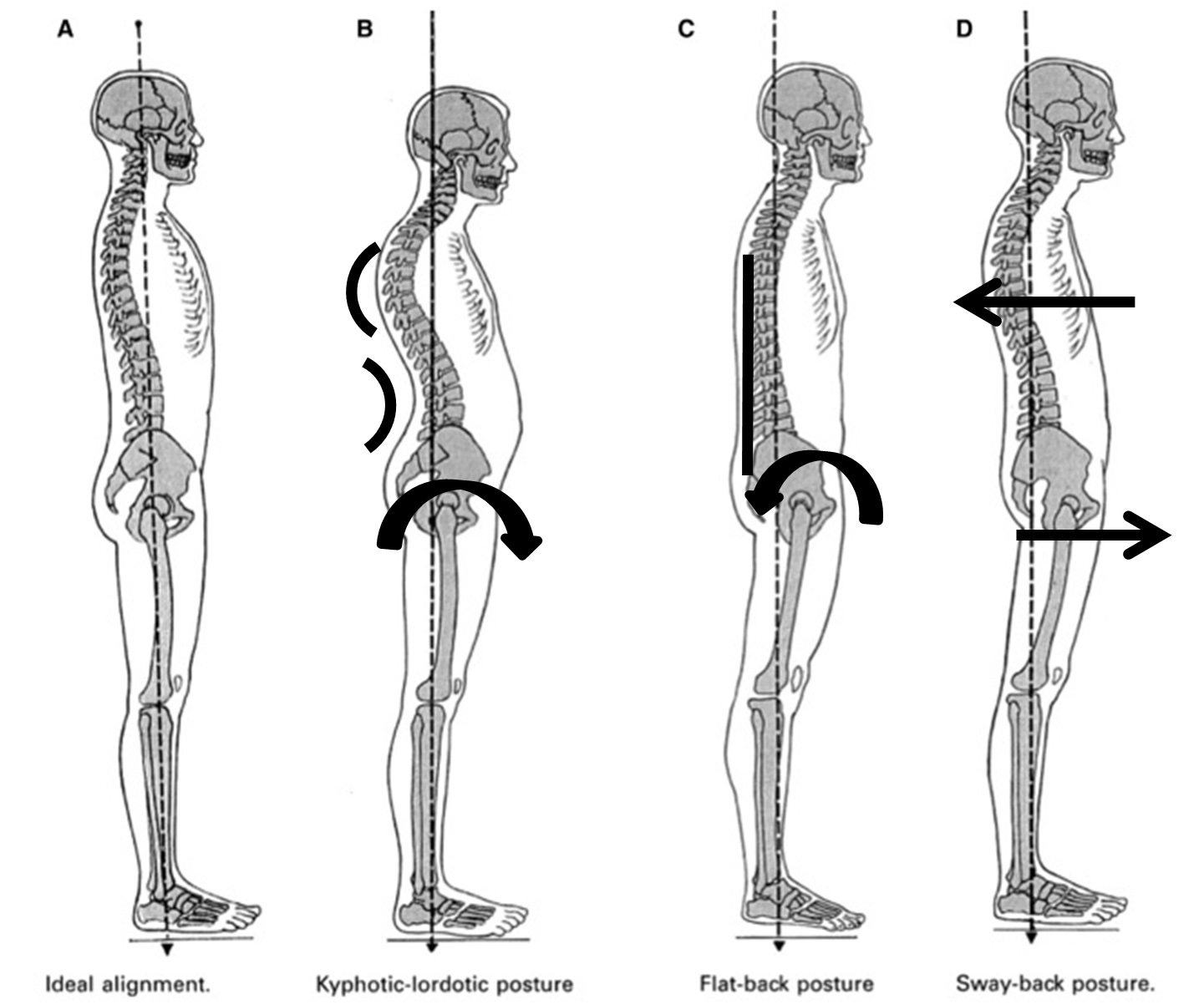 Posture Types | How To Improve Posture | Your Pilates Physio