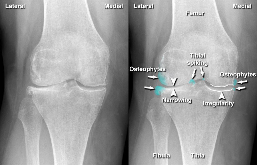Imaging of Musculoskeletal Disorders - Osteoarthritis