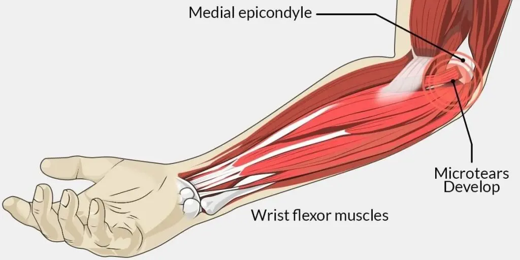 Golfer's Elbow - Causes, Symptons, & Treatments -Sound Pain Alliance