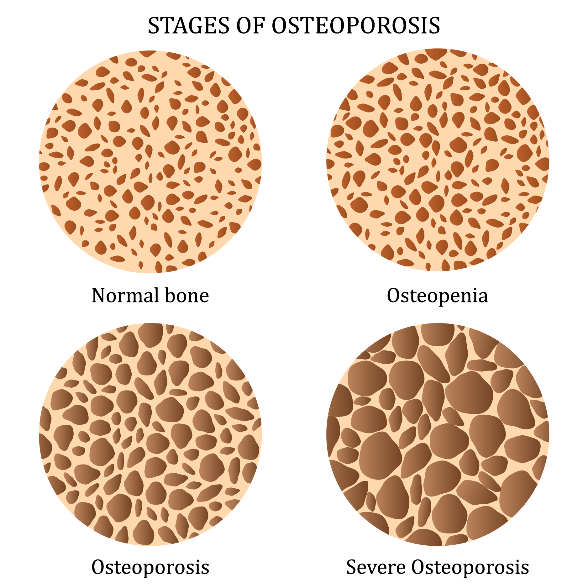 What Is Osteoporosis? | The Mayfair Clinic