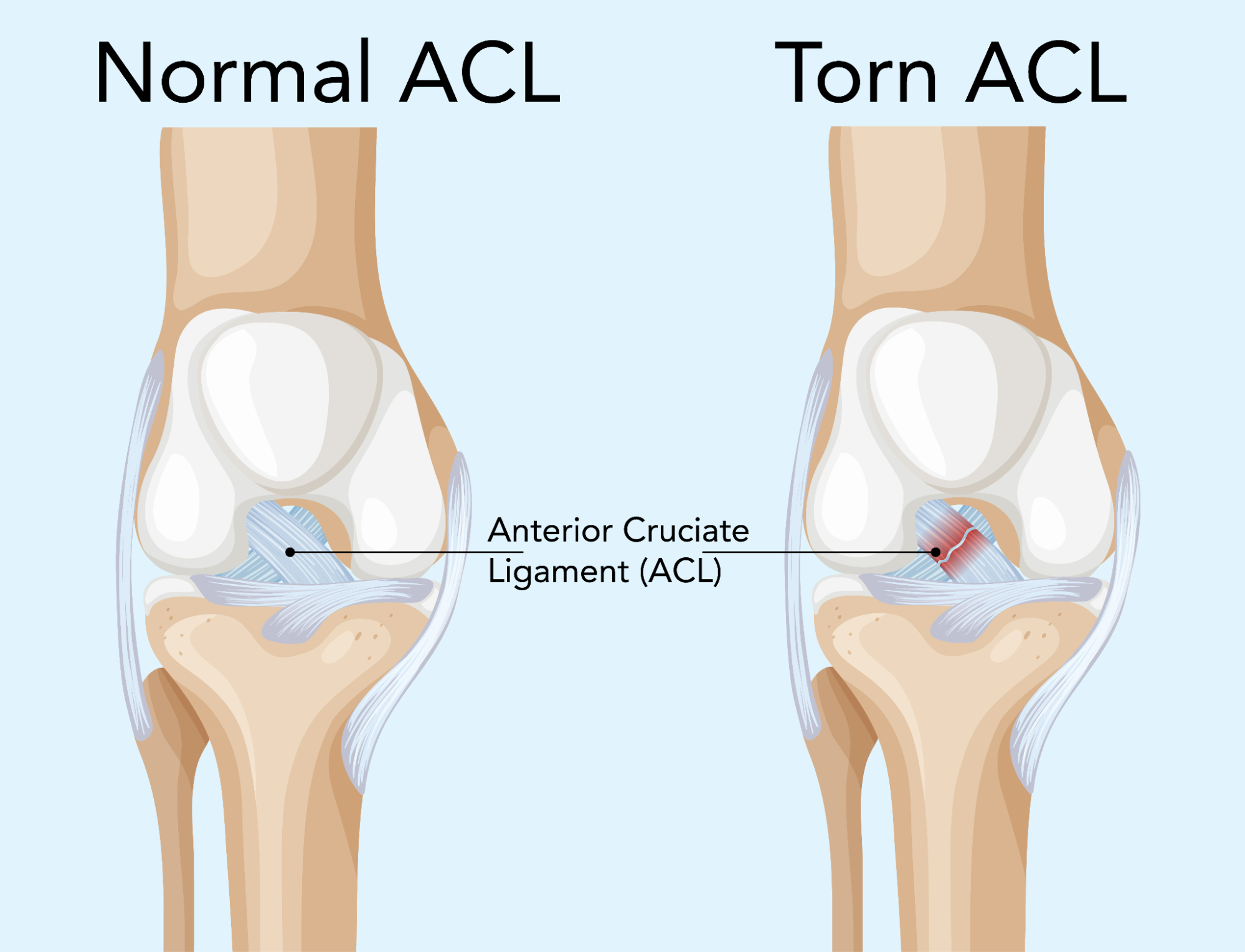 Understanding and Relieving the Anterior Cruciate Ligament (ACL)