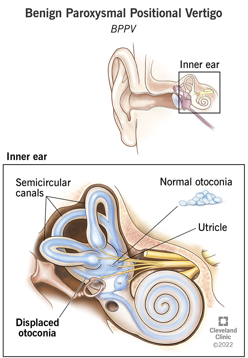 Benign Paroxysmal Positional Vertigo (BPPV): Causes & Treatment