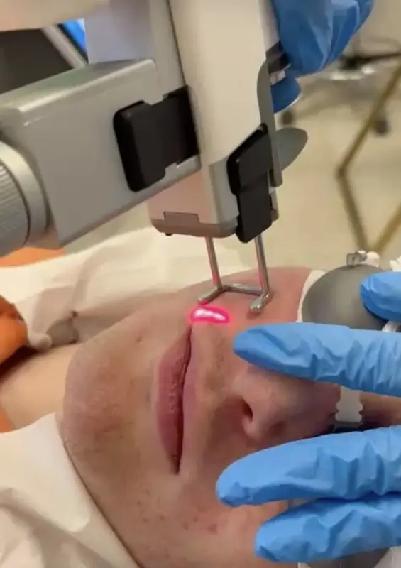 Laser Hybrydowy YouLaser Prime Warszawa