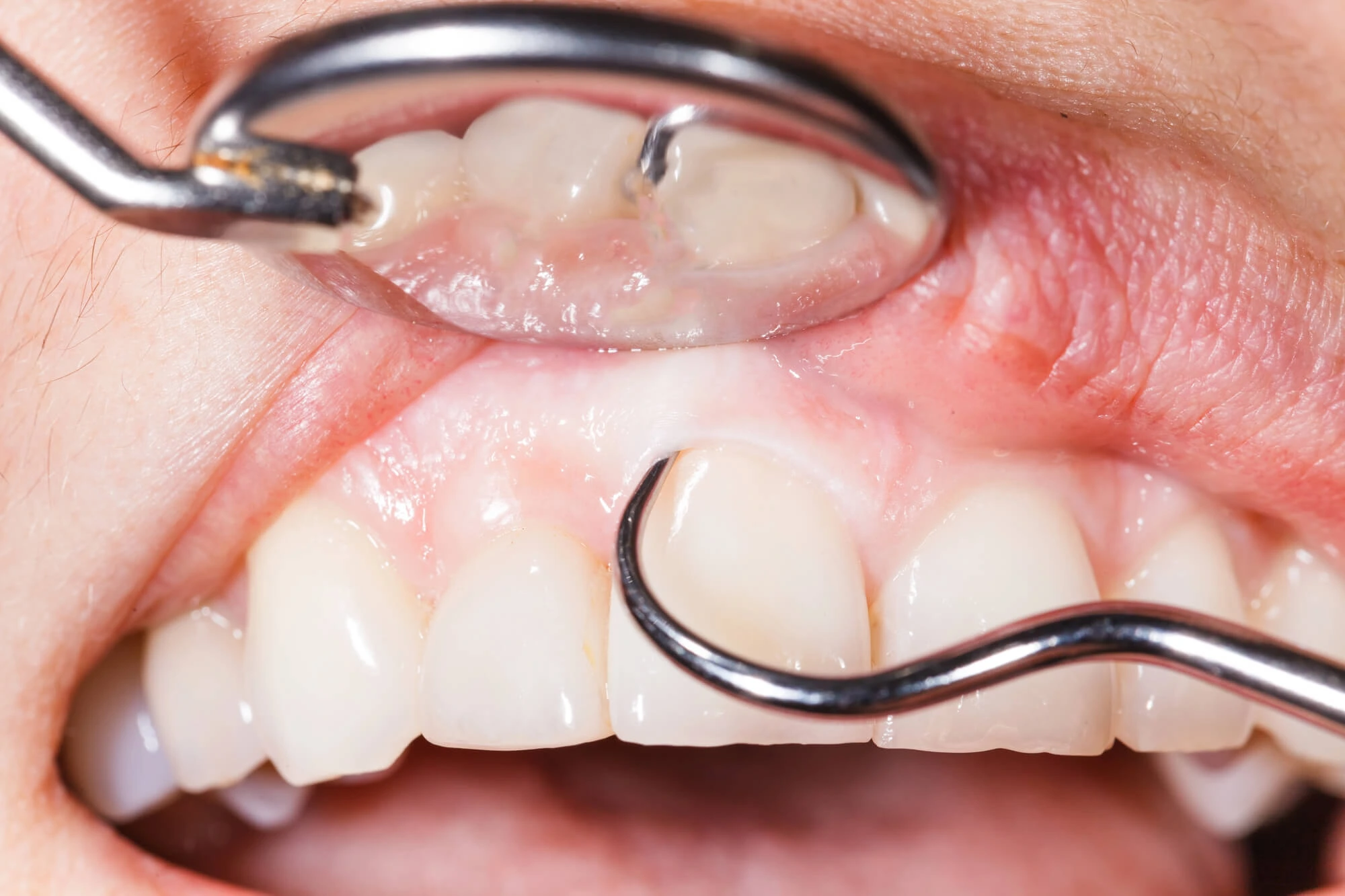 Gum Irritation Caused by Dental Crowns in Coral Gables