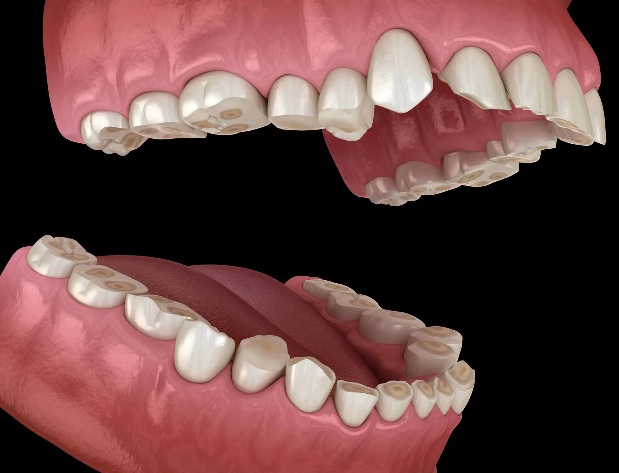Illustration of How Grinding Causes Enamel Wear by an Emergency Dentist in 33134